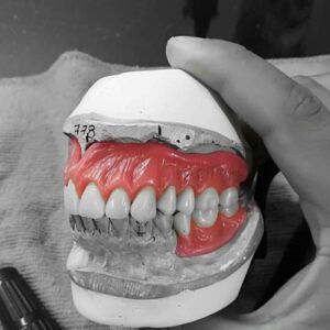 ساخت انواع دندان مصنوعی متحرک در منزل بیمار